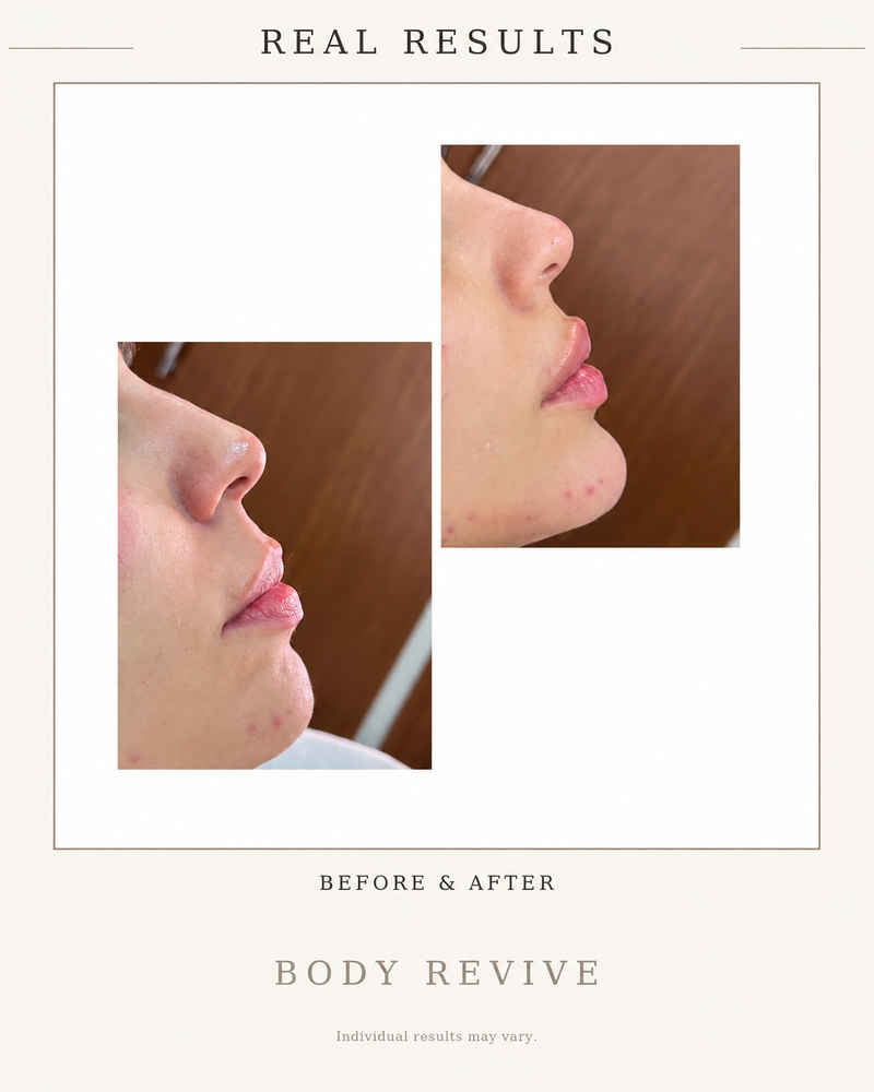 before_After_chin_Augmentation