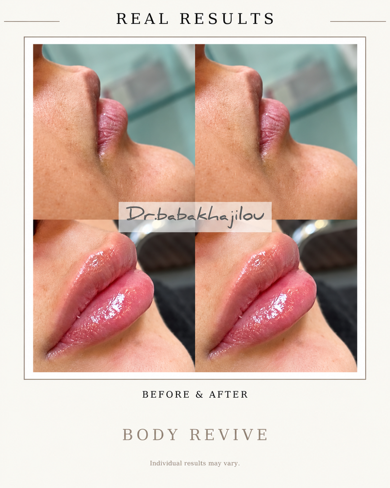 before and after lip filler